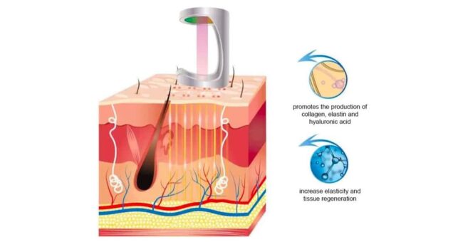 การรักษาด้วย Co2 Laser
