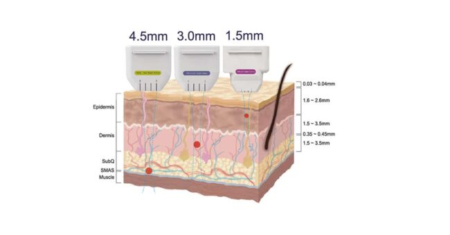 HiFU ความลึก