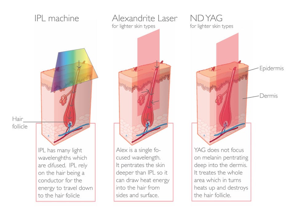 เปรียบเทียบ IPL Alexandrite ND YAG Laser