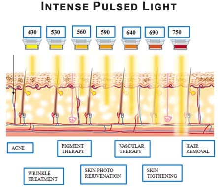 Intense Pulsed Light ( IPL )