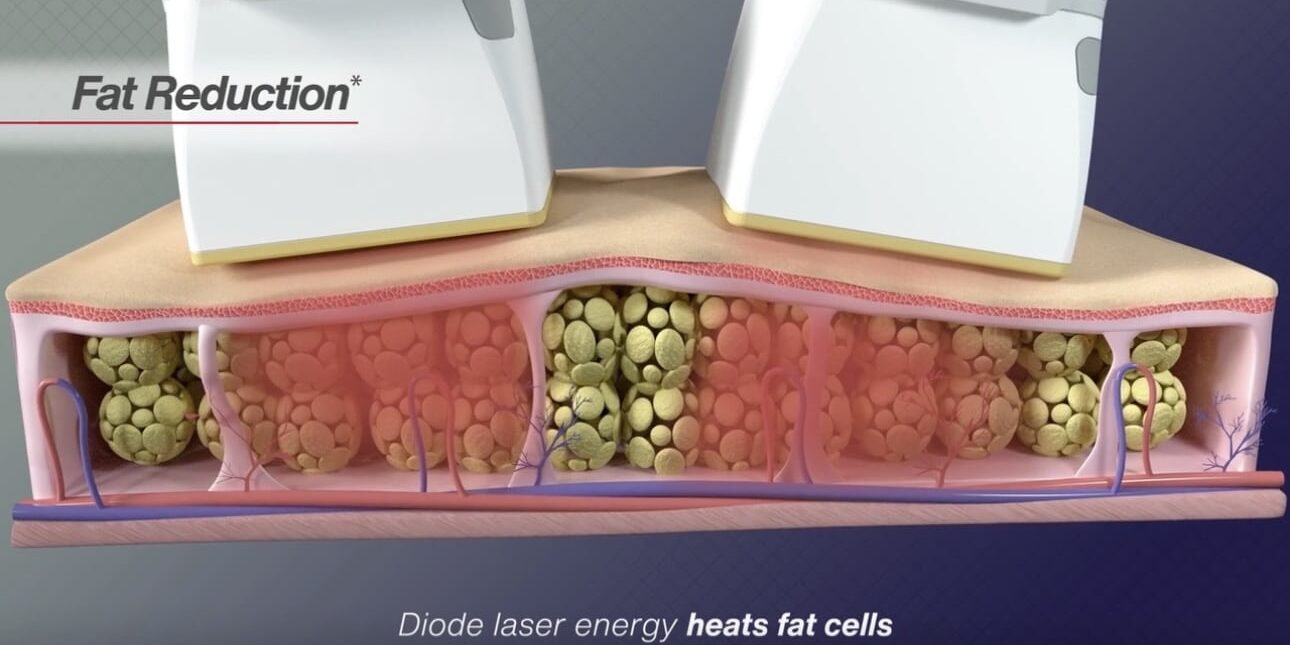 Diode Laser Fat Reduction Diode Laser Fat Reduction