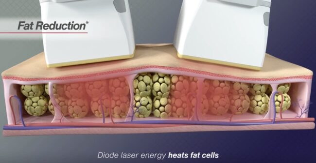 Diode Laser Fat Reduction