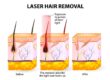 การกำจัดขนของ Diode Laser