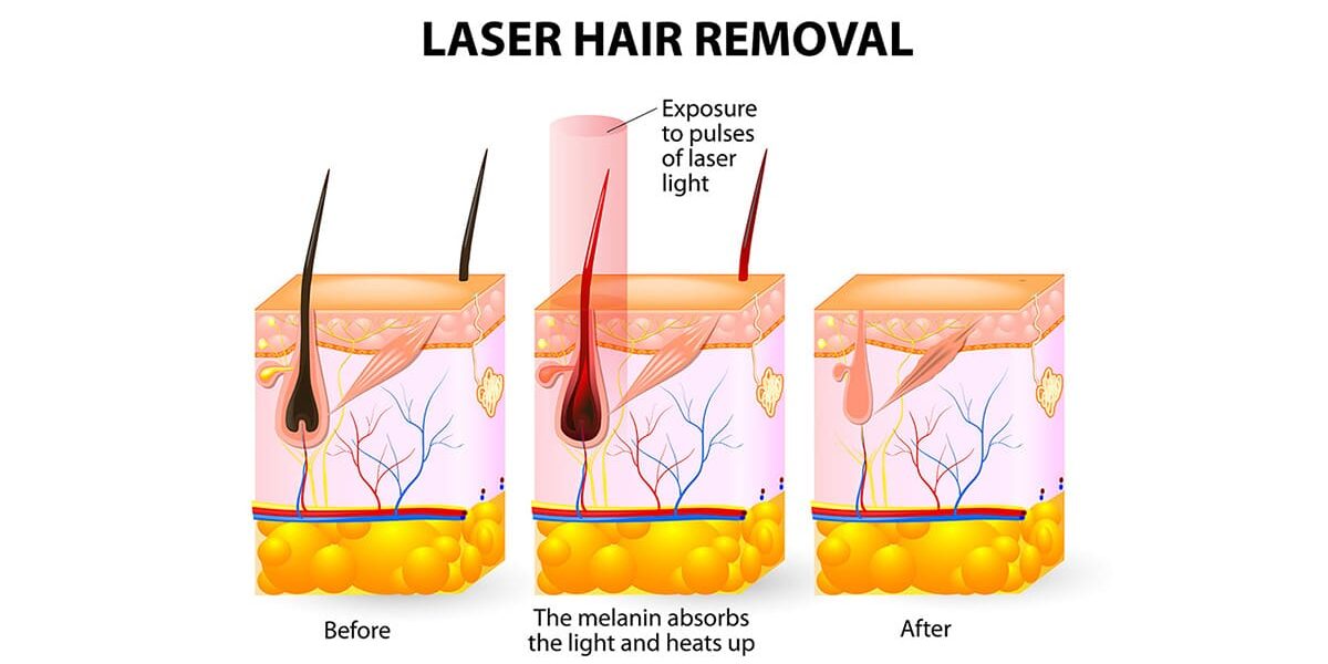 การกำจัดขนของ Diode Laser