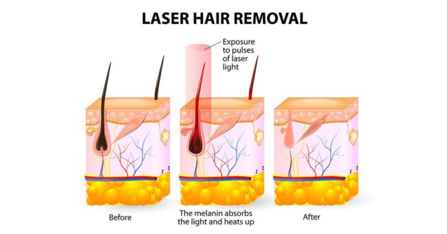 การกำจัดขนของ Diode Laser