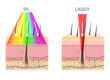 ข้อแตกต่างระหว่าง Laser กับ IPL
