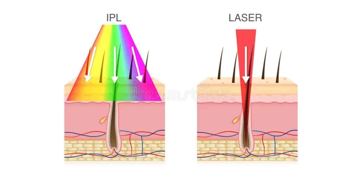ข้อแตกต่างระหว่าง Laser กับ IPL