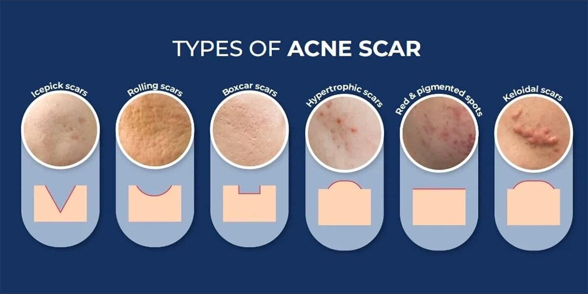ประเภทของหลุมสิว Types of Acne Scars