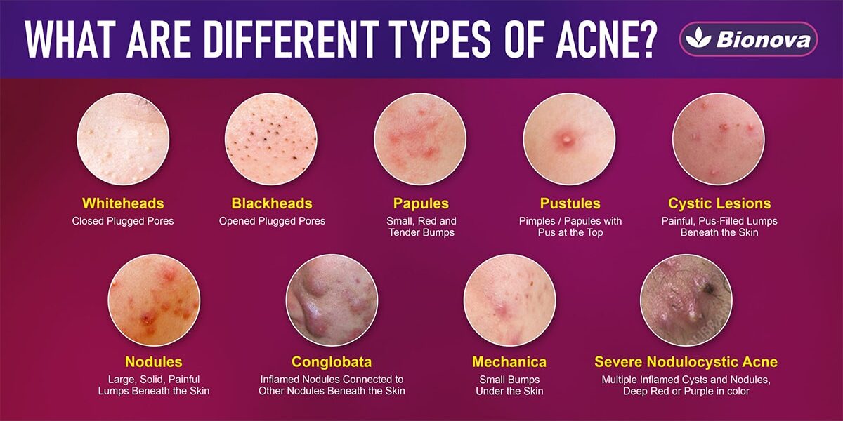 สิว ( Acne ) ประเภทต่างๆ