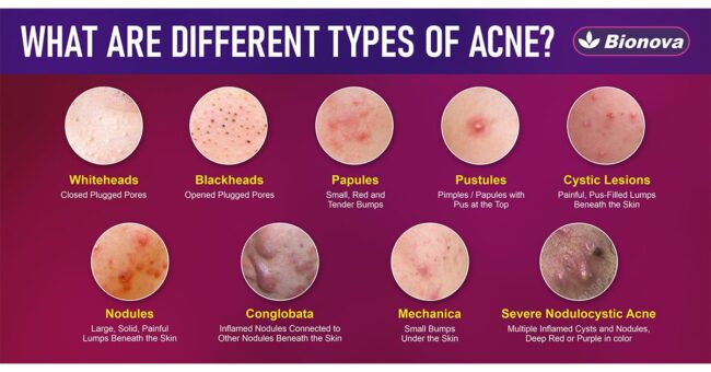 สิว ( Acne ) ประเภทต่างๆ