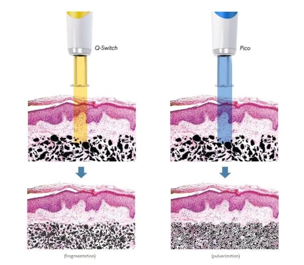 Q-Switch Laser vs Pico Laser อันไหนดีกว่ากัน