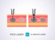 เปรียบเทียบ PICO VS Q Switch ND YAG Laser