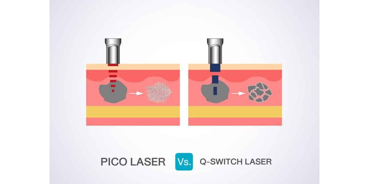 เปรียบเทียบ PICO VS Q Switch ND YAG Laser