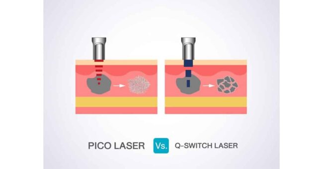 เปรียบเทียบ PICO VS Q Switch ND YAG Laser